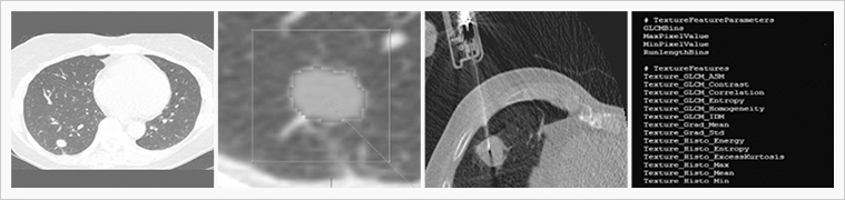 최첨단 영상 장비를 이용한 폐암의 특성 분석