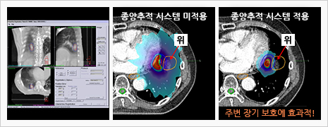 최신 방사선치료 장비를 이용한 실시간 종양추적 치료