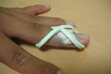 Finger splint 이미지