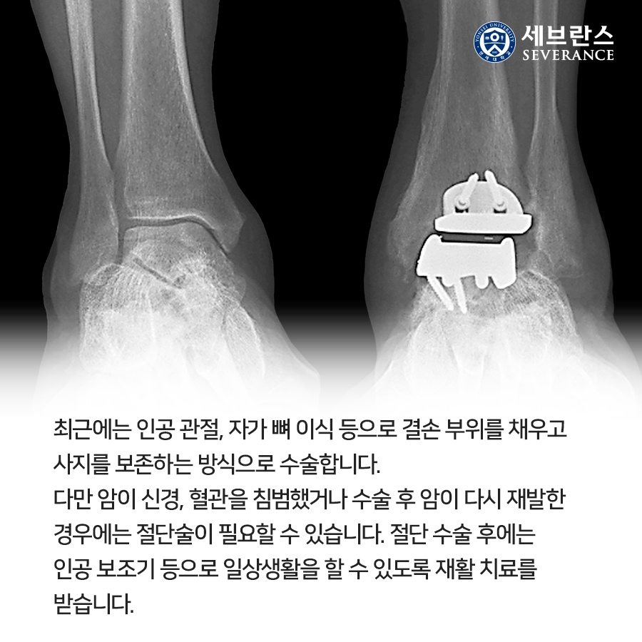 최근에는 인공 관절, 자가 뼈 이식 등으로 결손 부위를 채우고 사지를 보존하는 방식으로 수술합니다. 다만 암이 신경, 혈관을 침범했거나 수술 후 암이 다시 재발한 경우에는 절단술이 필요할 수 있습니다. 절단 수술 후에는 인공 보조기 등으로 일상생활을 할 수 있도록 재활 치료를 받습니다. 