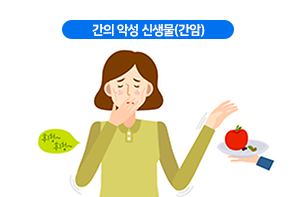  간의 악성 신생물(간암)