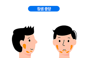 침샘 종양